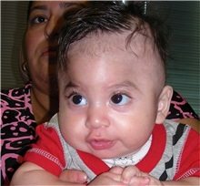 Craniosynostosis Before Photo by Rachel Ruotolo, MD; Garden City, NY - Case 36058
