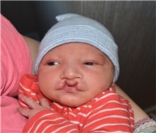 Cleft Lip and Palate Repair Before Photo by Rachel Ruotolo, MD; Garden City, NY - Case 36065
