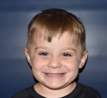 Craniosynostosis After Photo by Rachel Ruotolo, MD; Garden City, NY - Case 36072