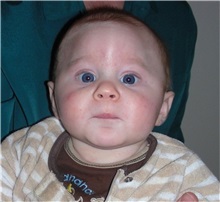 Craniosynostosis Before Photo by Rachel Ruotolo, MD; Garden City, NY - Case 36072