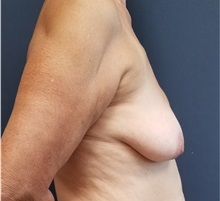 Breast Reconstruction Before Photo by Noel Natoli, MD, FACS; East Hills, NY - Case 36741