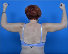 Arm Lift After Photo by Jonathan Weinrach, MD; ,  - Case 36767