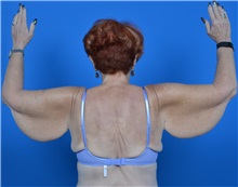 Arm Lift Before Photo by Jonathan Weinrach, MD; ,  - Case 36767