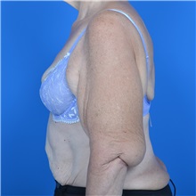 Arm Lift Before Photo by Jonathan Weinrach, MD; ,  - Case 36767