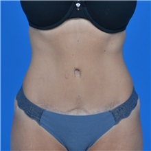 Tummy Tuck After Photo by Jonathan Weinrach, MD; ,  - Case 36780