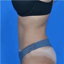 Tummy Tuck After Photo by Jonathan Weinrach, MD; ,  - Case 36780