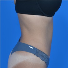 Tummy Tuck After Photo by Jonathan Weinrach, MD; ,  - Case 36780
