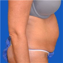 Tummy Tuck Before Photo by Jonathan Weinrach, MD; ,  - Case 36780