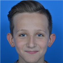 Ear Surgery Before Photo by Jonathan Weinrach, MD; ,  - Case 36838