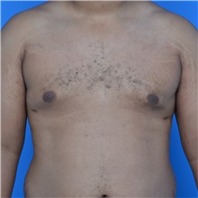 Male Breast Reduction After Photo by Jonathan Weinrach, MD; ,  - Case 36842