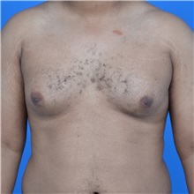Male Breast Reduction Before Photo by Jonathan Weinrach, MD; ,  - Case 36842