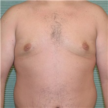 Male Breast Reduction After Photo by Jonathan Weinrach, MD; ,  - Case 36846