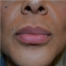 Lip Augmentation/Enhancement After Photo by Jonathan Weinrach, MD; ,  - Case 36867