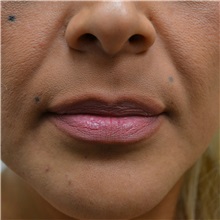 Lip Augmentation/Enhancement Before Photo by Jonathan Weinrach, MD; ,  - Case 36867