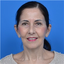 Facelift After Photo by Jonathan Weinrach, MD; ,  - Case 36884