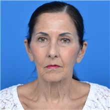 Facelift Before Photo by Jonathan Weinrach, MD; ,  - Case 36884