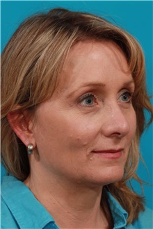 Brow Lift After Photo by Michael Bogdan, MD, MBA, FACS; Grapevine, TX - Case 36906
