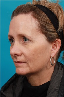 Brow Lift Before Photo by Michael Bogdan, MD, MBA, FACS; Grapevine, TX - Case 36906