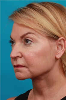 Facelift After Photo by Michael Bogdan, MD, MBA, FACS; Grapevine, TX - Case 37047