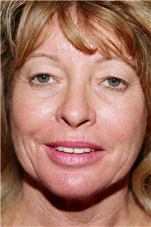 Facelift Before Photo by Steve Laverson, MD, FACS; Rancho Santa Fe, CA - Case 37390