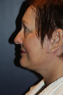 Facelift After Photo by Larry Weinstein, MD; Chester, NJ - Case 37442