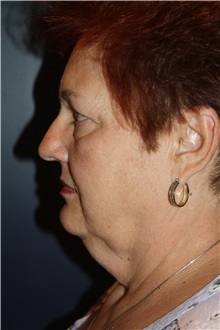 Facelift Before Photo by Larry Weinstein, MD; Chester, NJ - Case 37442