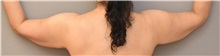 Arm Lift Before Photo by Keshav Magge, MD; Bethesda, MD - Case 37520