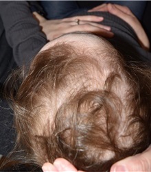 Craniosynostosis After Photo by Rachel Ruotolo, MD; Garden City, NY - Case 37785
