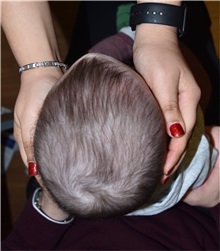 Craniosynostosis Before Photo by Rachel Ruotolo, MD; Garden City, NY - Case 37785