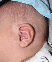 Ear Surgery After Photo by Rachel Ruotolo, MD; Garden City, NY - Case 37821