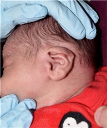 Ear Surgery Before Photo by Rachel Ruotolo, MD; Garden City, NY - Case 37821