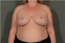Breast Reduction After Photo by Ellen Janetzke, MD; ,  - Case 37833