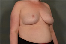 Breast Reduction After Photo by Ellen Janetzke, MD; ,  - Case 37833