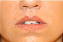 Lip Augmentation/Enhancement After Photo by Steve Laverson, MD, FACS; Rancho Santa Fe, CA - Case 37922