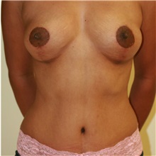 Mommy Makeover After Photo by Steve Laverson, MD, FACS; Rancho Santa Fe, CA - Case 37955