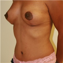 Mommy Makeover After Photo by Steve Laverson, MD, FACS; Rancho Santa Fe, CA - Case 37955