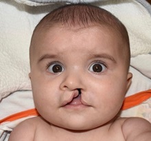 Cleft Lip and Palate Repair Before Photo by Rachel Ruotolo, MD; Garden City, NY - Case 38001