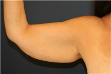 Arm Lift Before Photo by Steve Laverson, MD, FACS; Rancho Santa Fe, CA - Case 38062