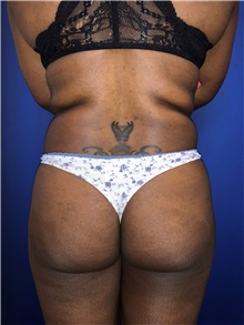 Buttock Lift with Augmentation Before Photo by Mark Markarian, MD, MSPH, FACS; Wellesley, MA - Case 38063