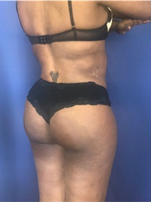 Buttock Lift with Augmentation After Photo by Mark Markarian, MD, MSPH, FACS; Wellesley, MA - Case 38063