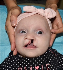 Cleft Lip and Palate Repair Before Photo by Rachel Ruotolo, MD; Garden City, NY - Case 38097