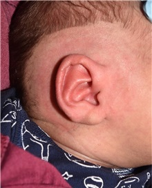 Ear Surgery After Photo by Rachel Ruotolo, MD; Garden City, NY - Case 38114