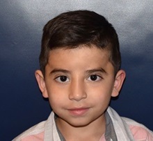 Craniosynostosis After Photo by Rachel Ruotolo, MD; Garden City, NY - Case 38129