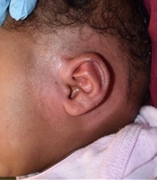 Ear Surgery After Photo by Rachel Ruotolo, MD; Garden City, NY - Case 38137