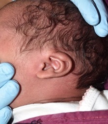 Ear Surgery Before Photo by Rachel Ruotolo, MD; Garden City, NY - Case 38137