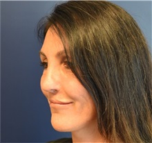 Rhinoplasty After Photo by Richard Reish, MD, FACS; New York, NY - Case 38323