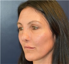 Rhinoplasty Before Photo by Richard Reish, MD, FACS; New York, NY - Case 38323