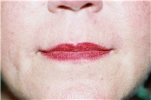 Lip Augmentation/Enhancement After Photo by Steve Laverson, MD, FACS; Rancho Santa Fe, CA - Case 38604