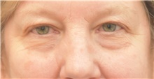 Eyelid Surgery Before Photo by Keshav Magge, MD; Bethesda, MD - Case 38627