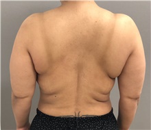Body Contouring Before Photo by Keshav Magge, MD; Bethesda, MD - Case 38640
